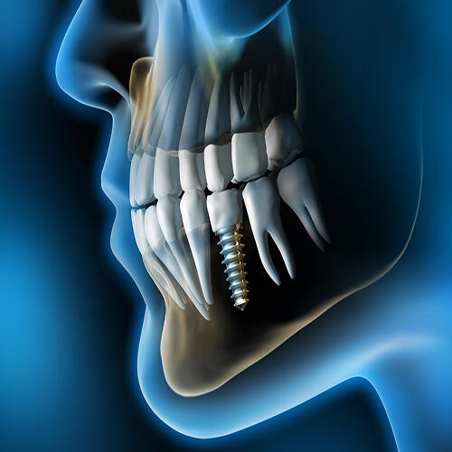 Medical Visualization Dental Implant in the Jaw 3D Rendering